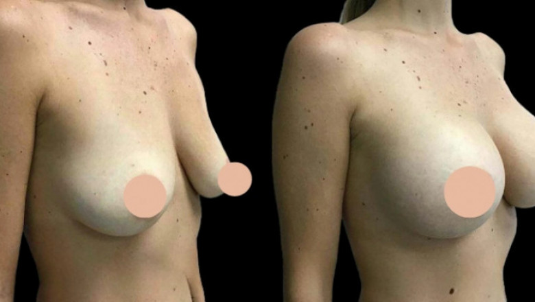 When Does Breast Augmentation in Dubai Show Full Results?