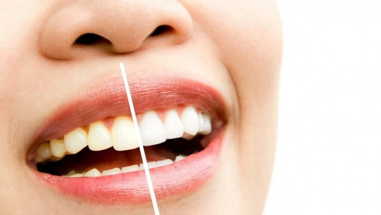 Caring for Your Crown Bridge Dental Work: Tips for Long-Lasting Results