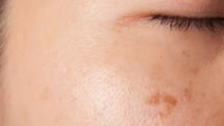 Understanding Actinic Keratosis Symptoms Treatment Options and Prevention Strategies for Sun Damaged Skin