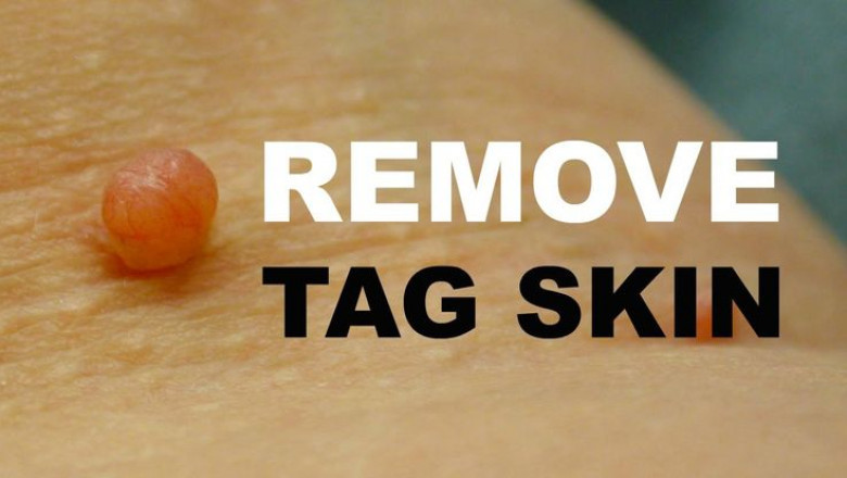 How Skin Tag Removal Leeds Can Improve Your Confidence
