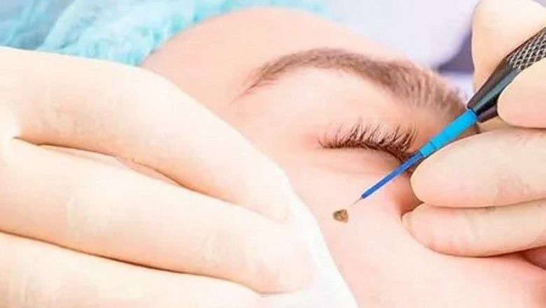 Wart Removal: Safe and Effective Remedies