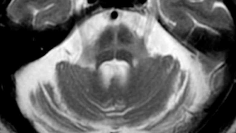 Multiple System Atrophy (MSA) Market: Size, Growth, and Strategic Insights
