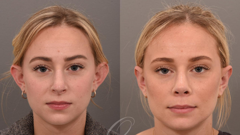 Adult Otoplasty: It’s Never Too Late to Reshape Your Ears