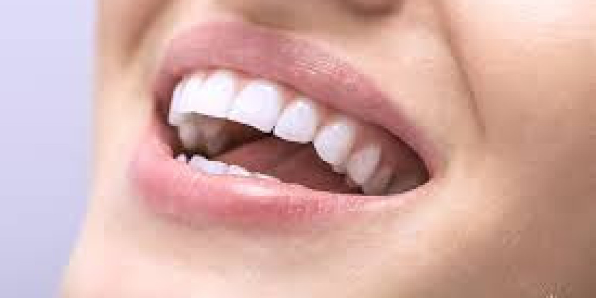 Emergency Dental Care: Minimizing Risks with Mouthguards