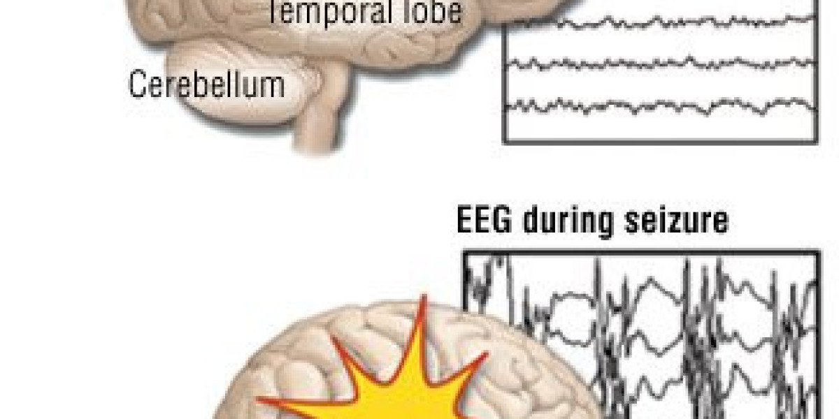 Focal (Partial) Epilepsy: Types, Causes, and Management