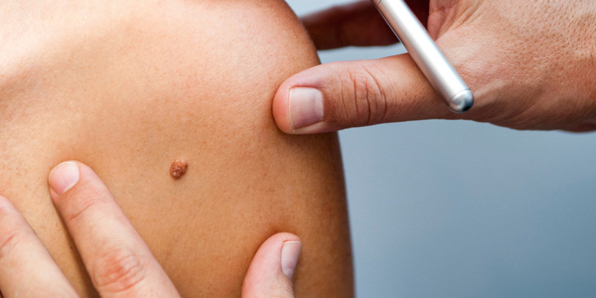 Removing Skin Tags on the Neck: Safe and Effective Methods