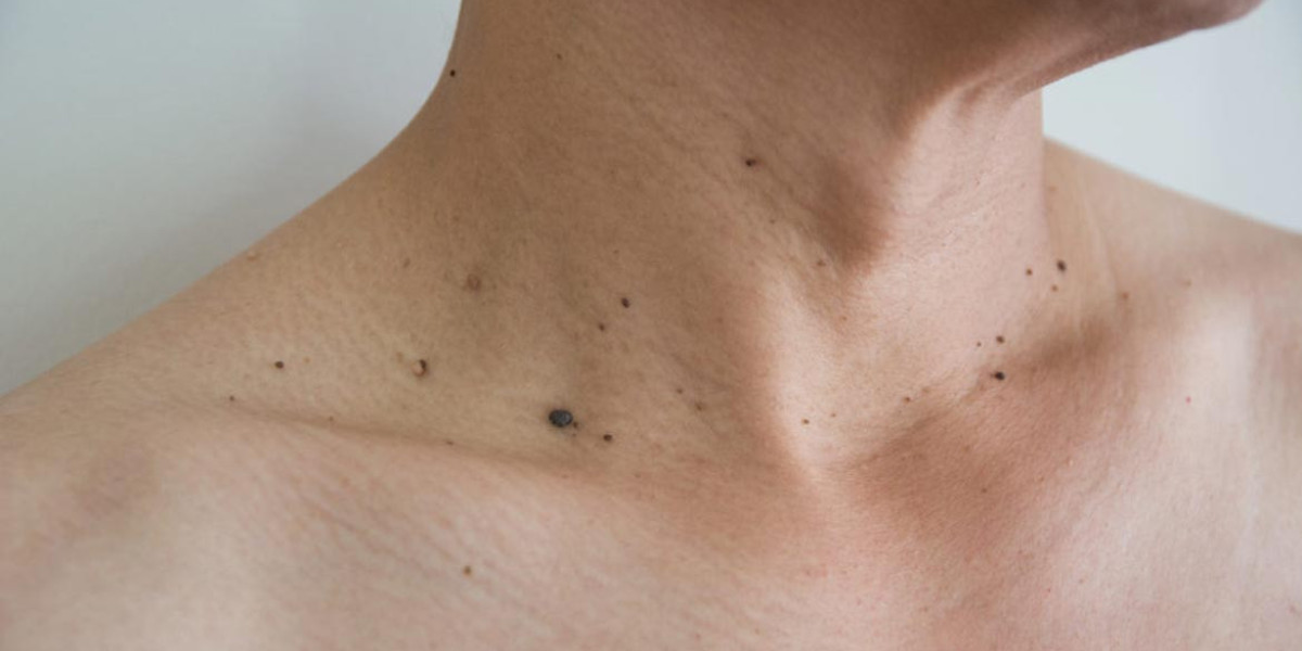 Skin Tag Removal: Understanding the Role of Genetics and Lifestyle