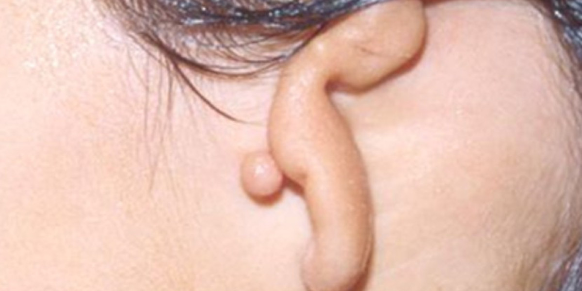 A Guide to Ear Reconstruction Surgery