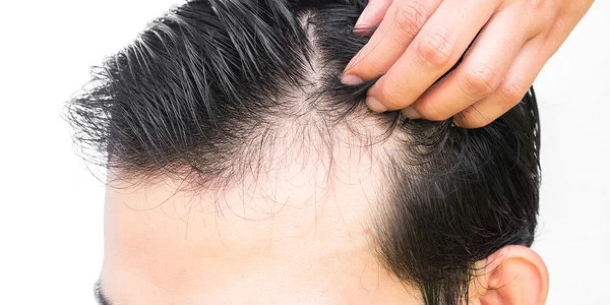 Hair transplant methods include FUT, FUE, and DHI