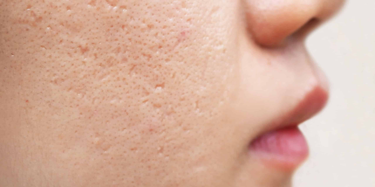 Acne Scars: Treatments & Benefits
