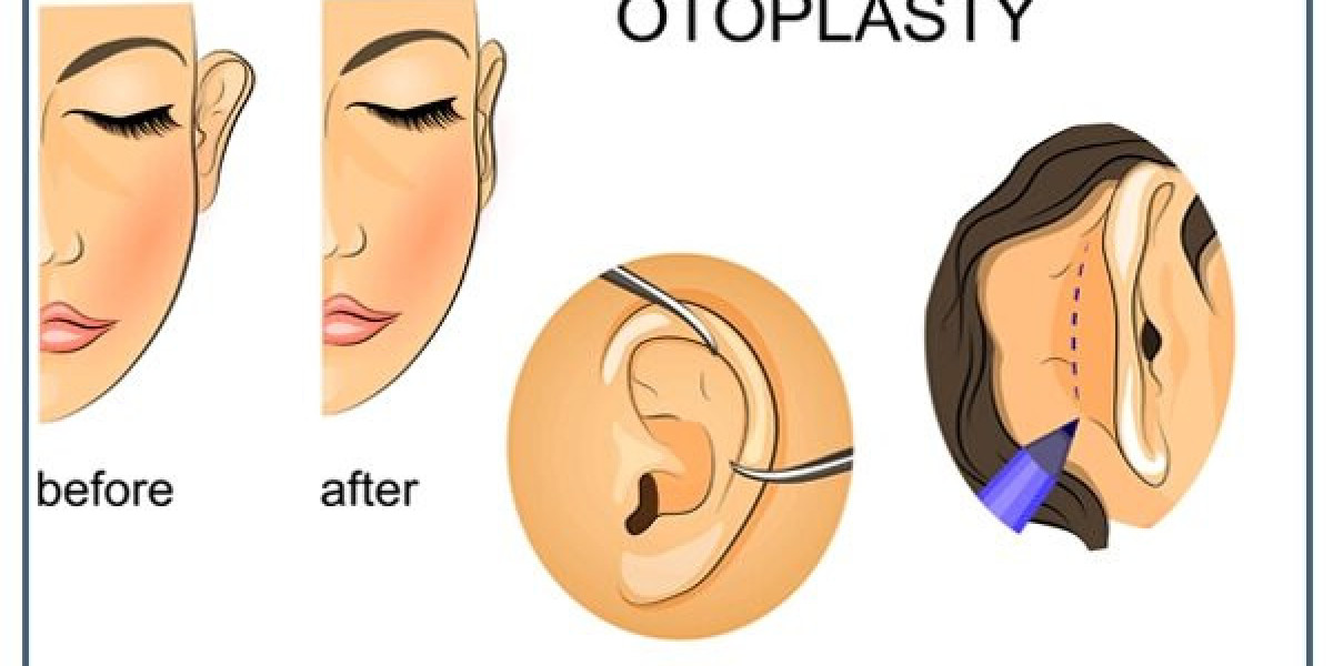 Otoplasty Surgery: Procedure and Benefits