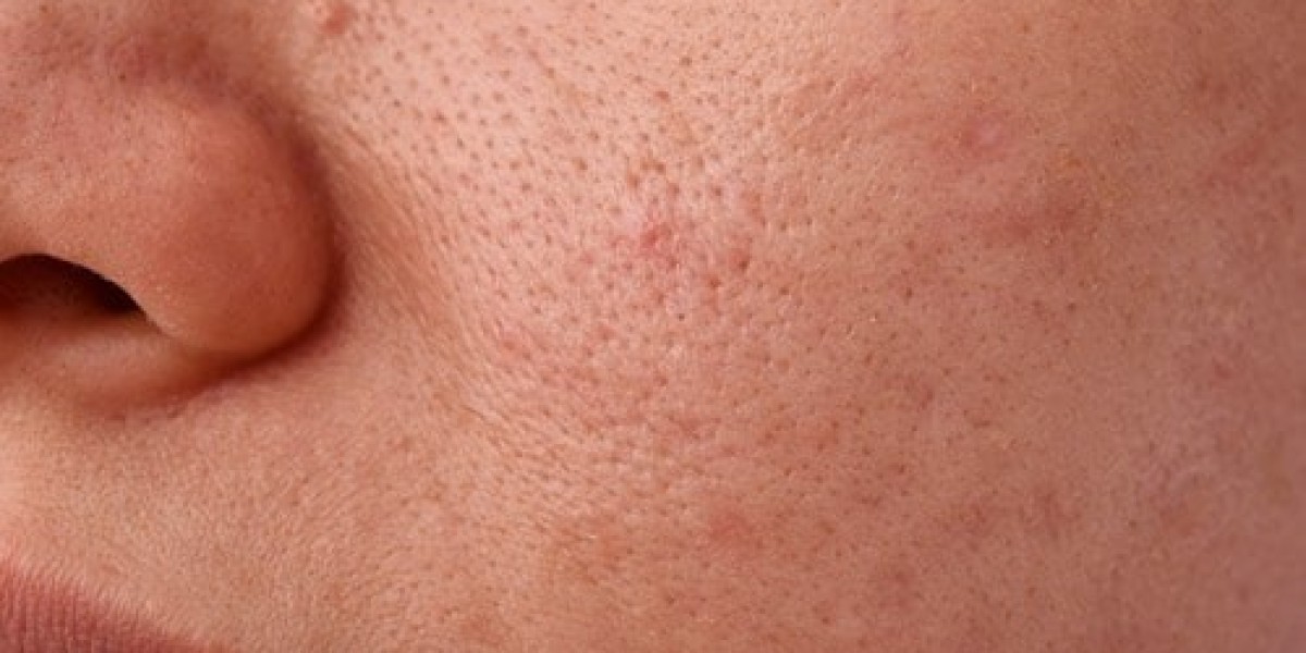 How Can I Prevent Open Pores on the Face?