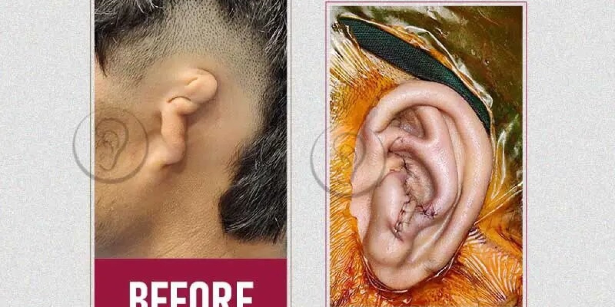 Everything One Needs To Know About Ear Reconstruction Surgery