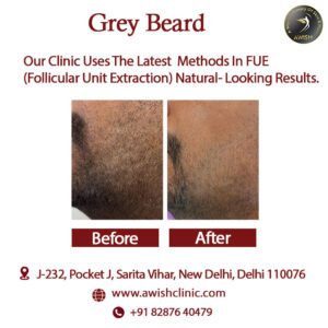 Best Grey Beard Treatment | Grey Beard Treatment in Delhi - AWISH CLINIC