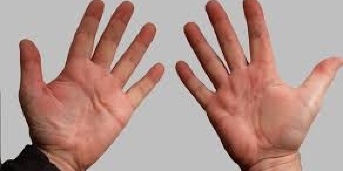 When Is the Best Time to Treat Dupuytren’s Contracture?