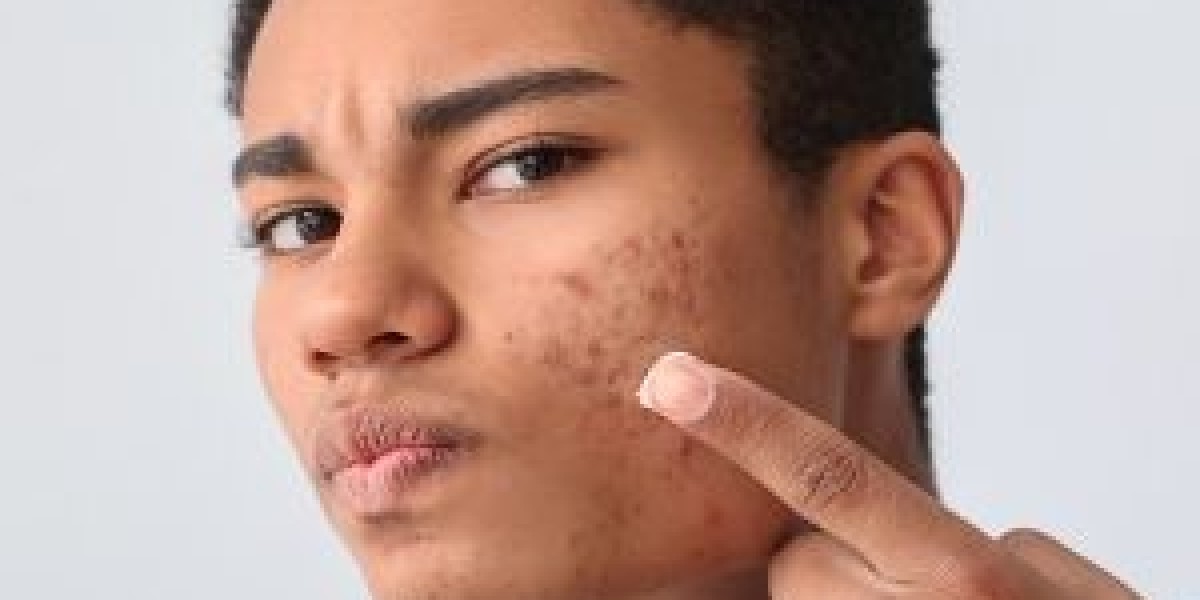 What Causes Acne and How Can You Treat It in Islamabad?