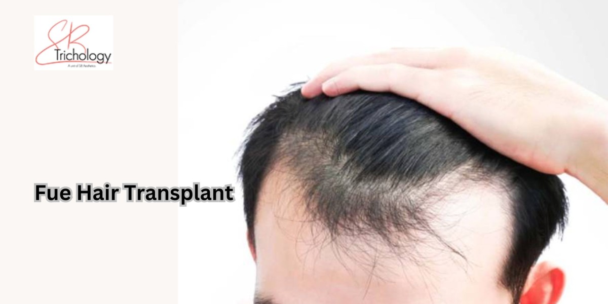 PRP vs. FUE Hair Transplant: Which Is Better for You?