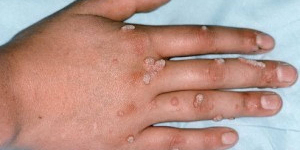 Top 5 Effective Warts Removal Treatments in Islamabad