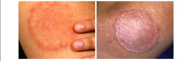 Granuloma Annulare vs Ringworm: Symptoms, Treatments and More - Herbal Care Products