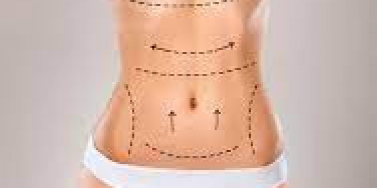 The Ultimate Guide to Liposuction Surgery in Riyadh: What You Need to Know