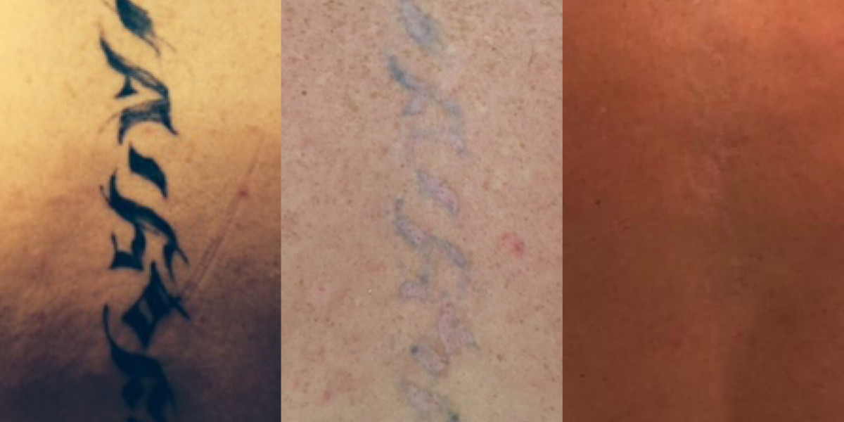 Is It Possible To Have A Complete Laser Tattoo Removal In London?