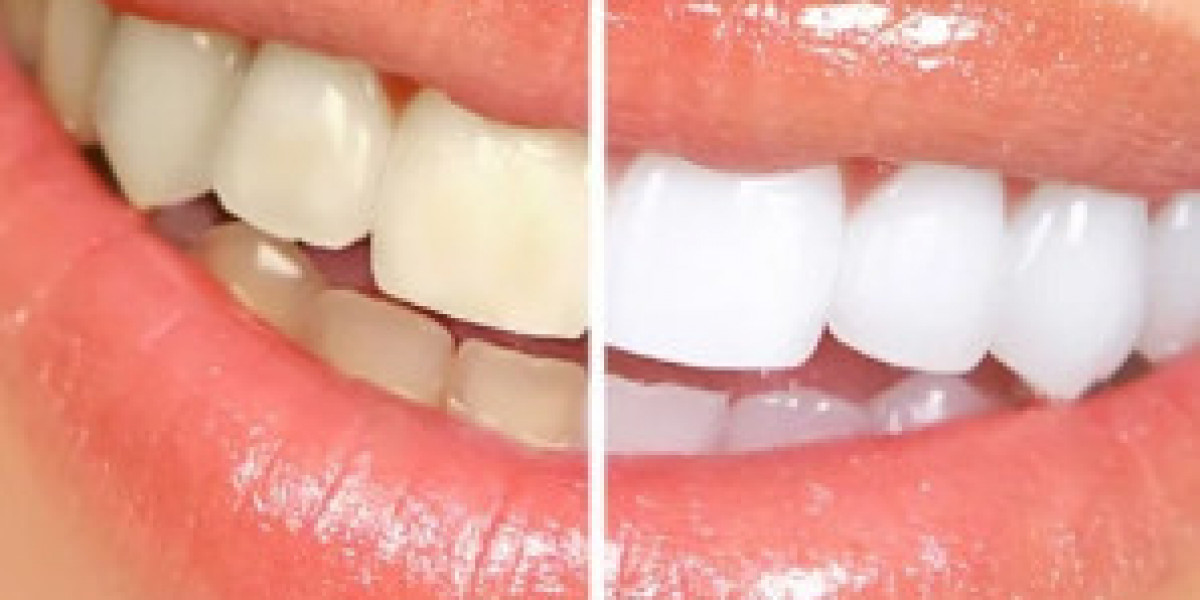 Achieve a Stunning Smile with This Proven Teeth Whitening Solution