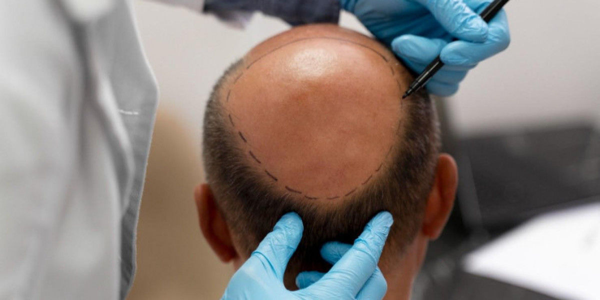 Top 6 Questions About the Hair Transplant