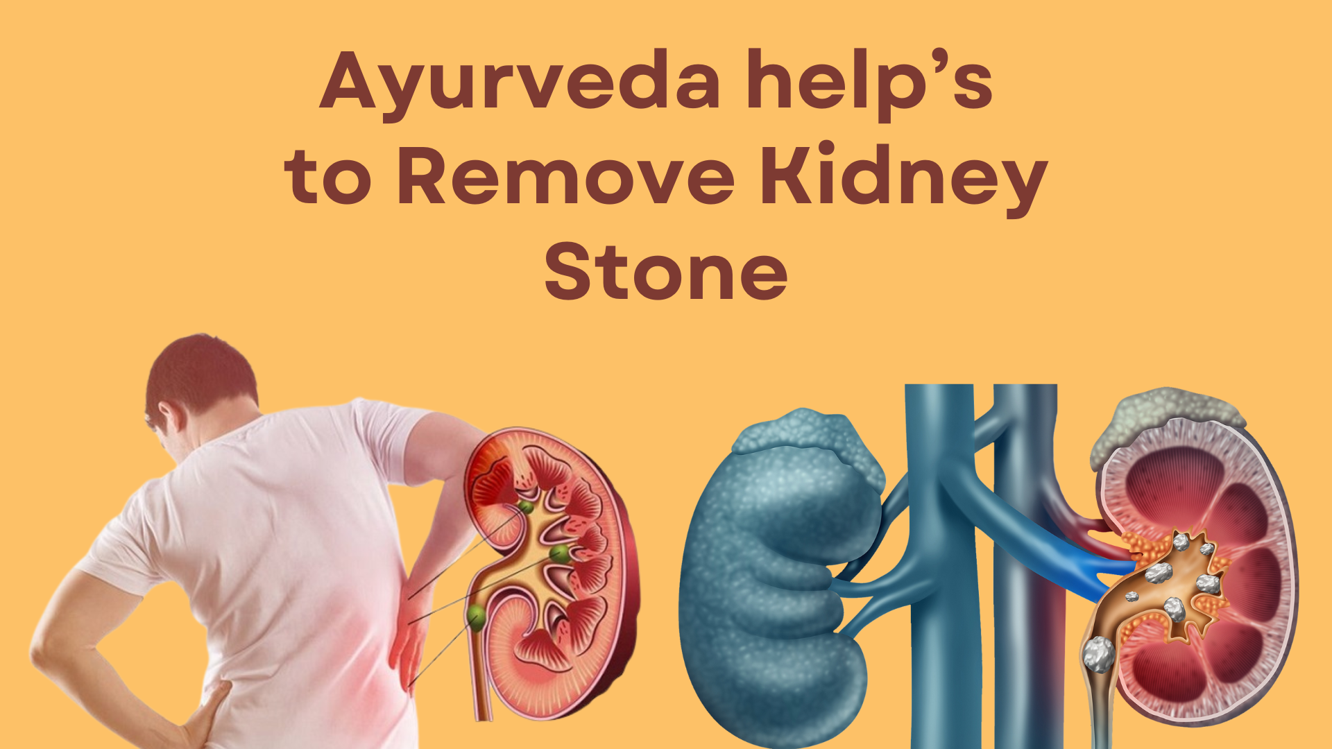 Ayurveda Help's To Remove Kidney Stones