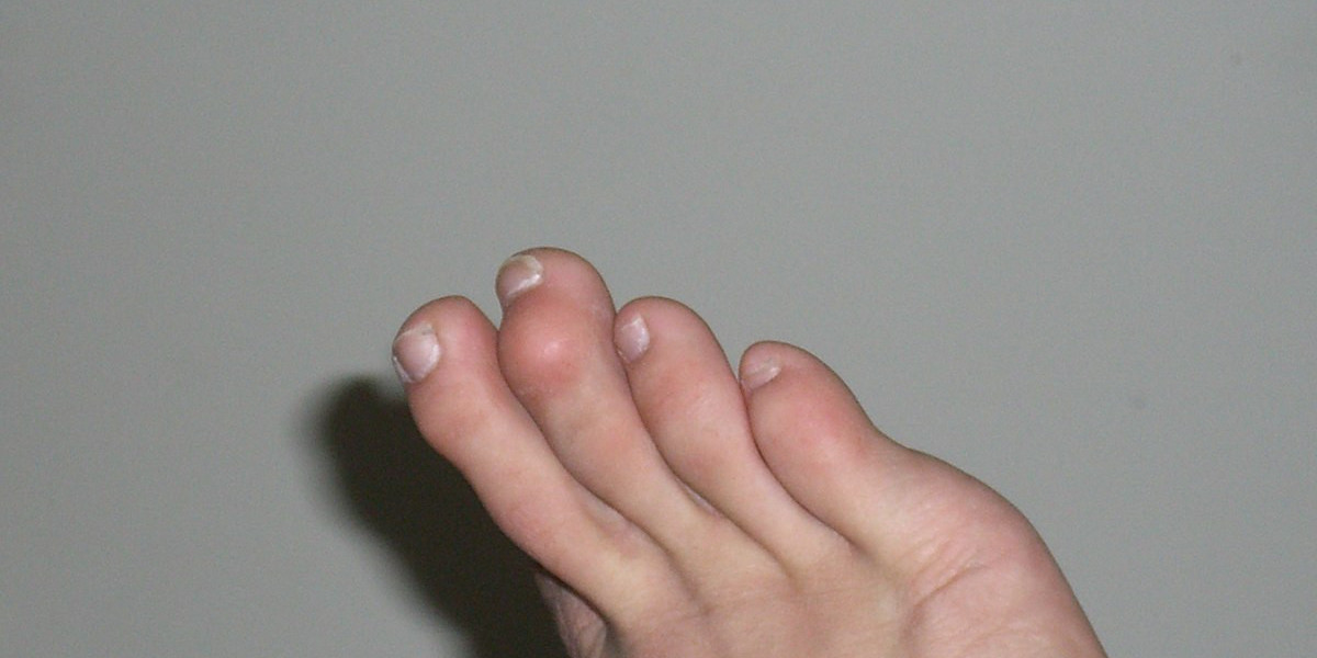 Understanding Mallet Toes, Expert Footcare in Edinburgh