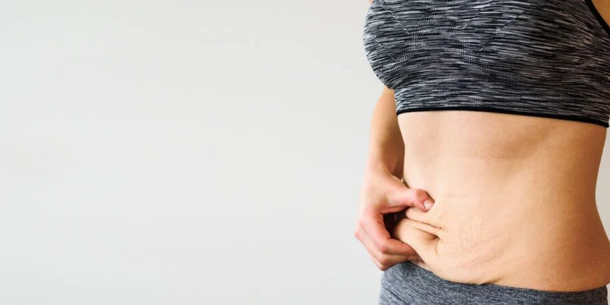 Stretch Marks: Causes, Treatment Options and Prevention